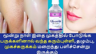 இதை இப்படி பயன்படுத்துங்க கரும்புள்ளி பருக்கள் தழும்பு மறைந்து வெள்ளையாகிவிடும்  glycerin [upl. by Vedi]