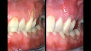 Treatment for Receding Gums [upl. by Sura]