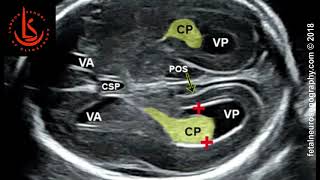 Fetal lateral ventricle measurements How to measure posterior ventricle for ventriculomegaly [upl. by Jedd]