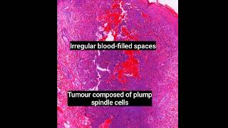 Histopathology of Aneurysmal Dermatofibroma dermpath dermatopathology pathology shorts [upl. by Borchert]