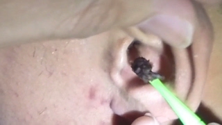 Mans Dark Giant Earwax Removal [upl. by Weeks850]