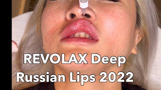 Beautiful Lips 2022  Lips Filler  Russian lips and REVOLAX Deep [upl. by Denison]