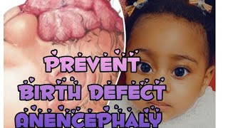 Anencephaly Birth defect explained How to prevent it 2 [upl. by Emee454]