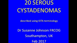 serous cystadenomas YouTube Feb 2017 [upl. by Jun]