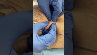 IMG 2540 PUSHING OUT A SEBACEOUD CYST [upl. by Toole]