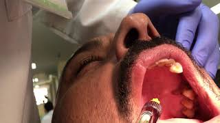 Palatal Anesthetic Infiltration Technique [upl. by Mcneil]