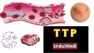 Thrombotic thrombocytopenic purpuraHemolytic uremic syndrome In urduHindiDoctors goalanimation [upl. by Esadnac]