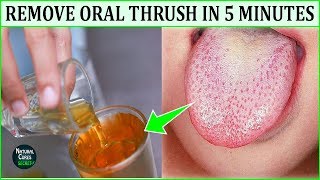 How to Get Rid of Oral Thrush Naturally In 5 Minutes  Oral Thrush Home Remedies  Dental Hygiene [upl. by Raffaj]