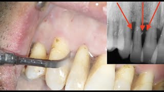 Igiene professionale scaling e root planing con strumenti sonici [upl. by Thorman]