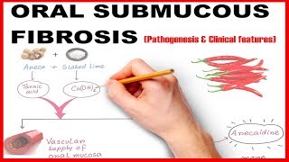 Oral Submucous Fibrosis OSMF  Pathogenesis and Clinical Features [upl. by Robbie975]