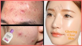 How to Get Rid of Pimples Acne Skin Rashes Prickly Heat Overnight  Lacto Calamine Benefits [upl. by Hagai219]