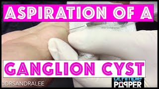 Aspiration of a ganglion cyst [upl. by Corby]