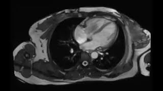 View of Cardiac Magnetic Resonance Imaging [upl. by Aniretak]