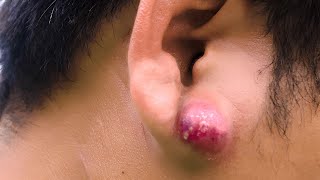 Ear Abscess [upl. by Mohun]