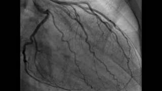 Cardiac Catheterization Heart video [upl. by Nylrebma]