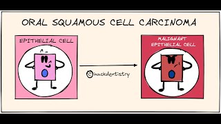 Oral squamous cell carcinoma  Etiology and Pathogenesis [upl. by Aryc731]