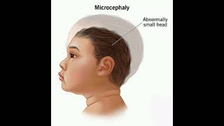 Microcephaly History mrcpch Clinical [upl. by Kozloski]