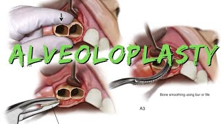 Alveoloplasty [upl. by Nueormahc]