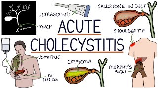 Understanding Acute Cholecystitis [upl. by Trill175]