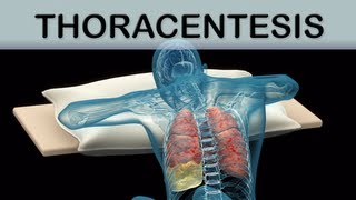 Thoracentesis Medical Animation [upl. by Corette]