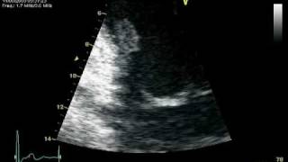 RUPTURE CHORDAE POSTEROMEDIAL PAPILARY MUSCLE  MR PROLAPSE [upl. by Barden]