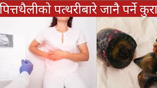 Gall stones in nepaliDr Bhupendra Shahdoctor sathi [upl. by Ardnasxela]