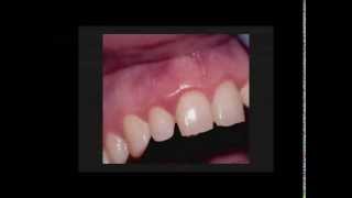 Precise LTM Periodontal Curretage Clinical Procedure [upl. by Ludly]