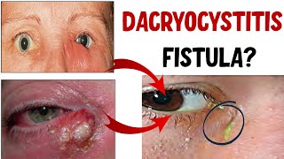 DACRYOCYSTITIS Lacrimal Sac Infection Stages Complications and Treatment [upl. by Nnylyak121]