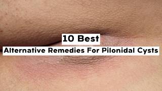 10 Alternative Remedies For Pilonidal Cysts [upl. by Sheets]