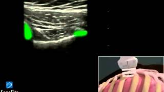 3D Cómo hacer EFAST  Detección de Deslizamiento Pulmonar con Transductor Lineal [upl. by Nywnorb]