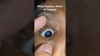 Leukocoria  White Pupillary Reflex of cataract [upl. by Mello]