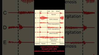 aortic regurgitation murmur apex beat mcqs important points [upl. by Ahsihat]