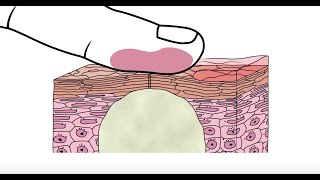 Using glycolic acid to help clear acne  Acneorg [upl. by Elok793]