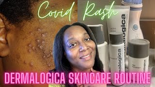 Dermalogica Skin Care Review Helped Me Get Rid of Severe Acne and Dark Spots Clear Glowing Skin [upl. by Kwan]