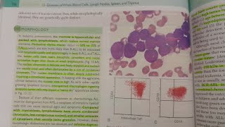 Acute Lymphoblastic Leukemia  SPECIAL PATHOLOGY [upl. by Engud]