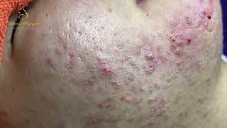 Loan Nguyen Acne Treatment 15677 [upl. by Falzetta784]