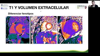 Las tres principales miocardiopatías de Latinoamérica  Dr Enrique Berríos [upl. by Darya]