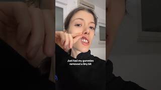 Dentist Reveals How To Fix Your GUMMY Smile 😁🦷 [upl. by Brigit]