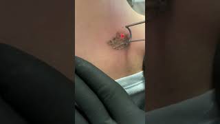 aparat laser indepartare tatuaje [upl. by Oniskey]