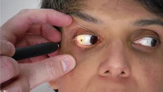 Common Eye Diseases  Conjunctivitis and Cataracts [upl. by Ailecara]