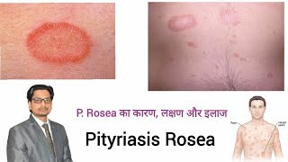 Pityriasis Rosea  P Rosea का कारण लक्षण और इलाज pityriasis rosea treatment in hindi prosea [upl. by Ayanej256]