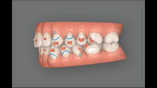 Invisalign clincheck Treatment simulation to corect an open bite for adult patient [upl. by Dao]