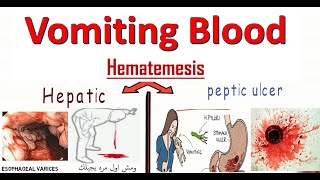 Hematemesis in Emergency تعمل ايه مع حالات ترجيع الدم فى الاستقبال والطوارئ [upl. by Furlong]