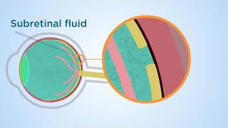 Subretinal fluid a novel approach to macular holes [upl. by Atalee]