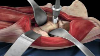 Direct Anterior Approach Hip Replacement [upl. by Sihon]