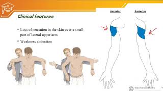 Axillary nerve injury [upl. by Mafala]