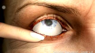 Blepharitis [upl. by Keelby]