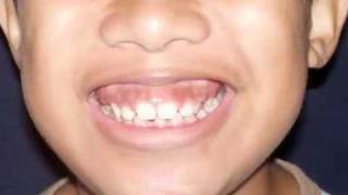 ORTHODONTIC TREATMENT  7 DEEPBITE DR DEAN A CESA [upl. by Fishman]