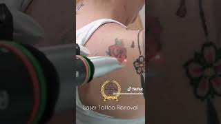 Laser tattoo removal Roses tattoo tattooremoval tattooremovalmethods advancedaestheticclinic [upl. by Ynagoham]