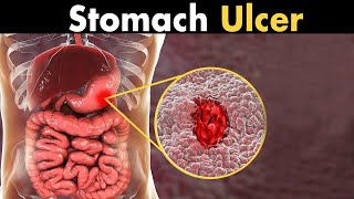 What causes a stomach ulcer [upl. by Aicirtal]